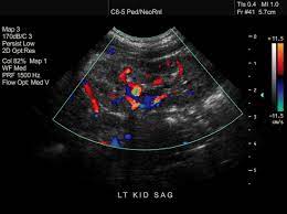 Staging head and neck cancers Ultrasound Scans How Do They Work