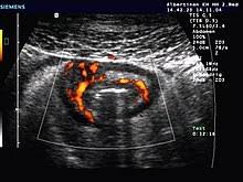Morbus Crohn Wikipedia