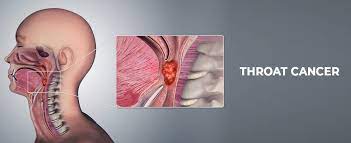 Find answers to health issues you can trust from healthgrades.com. Throat Cancer Don T Take The Signs For Granted Jupiter Hospital