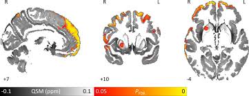Parkinson's disease (pd) is a progressive neurodegenerative movement disorder affecting over 10 million this work provided the rationale for the return of pallidotomy, and subsequently deep brain. Mri Reveals Brain Changes From Parkinson S Disease