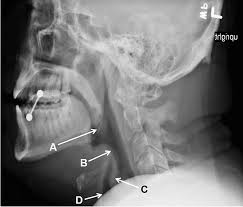 Image result for Epiglottitis