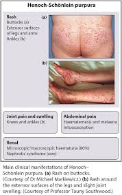 Hsp may be a response to a viral or bacterial infection, but ultimately there is no consensus on the cause. Clinical Manifestations Of Henoch Schonlein Purpura Diagnosis Grepmed