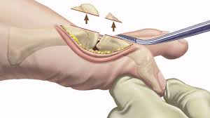 A top of the foot bone spur is very common, especially in someone with a very high arched foot. Arthritis Of The Big Toe Diagnosis And Treatment At Holy Cross Orthopedic Institute Youtube