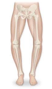 Image result for Genu Varum