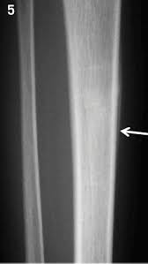 Image result for Tibia Stress Fracture