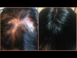 Grow Long Thick Hair Get Rid Of Bald Spot Thin Hair Dry Scalp Khichi Beauty Youtube Grow Thick Long Hair Thick Hair Styles Grow Thicker Hair