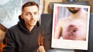 Immer wieder wird uns erzählt, dass es schwierig sei, gleichgesinnte zu finden. Loch In Der Brust Youtube Star Philipp Mickenbecker Ist Unheilbar Krank Hessen