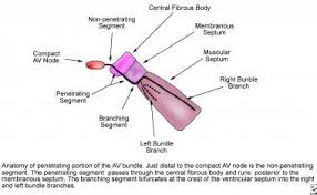 Image result for Right Bundle Branch Block