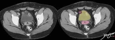 Endometriosis is a condition where tissue similar to the lining of the womb starts to grow in other places, such as the ovaries and fallopian tubes. Endometriosis Of The Bladder On Ct Scan Art In Anatomy