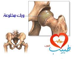 خلع الورك الولادي Congenital Hip Dislocation