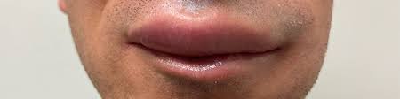 Image result for Angioedema