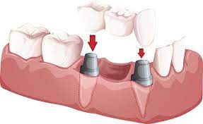 Dental Bridges Faqs Schmidt Dds St Louis Mo