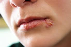 Herpes Im Mund Ausloser Und Behandlung Heilpraxis