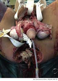 Maybe you would like to learn more about one of these? Fournier S Gangrene Caused By Streptococcus Anginosus A Rare Etiologic Agent Revista De Gastroenterologia De Mexico