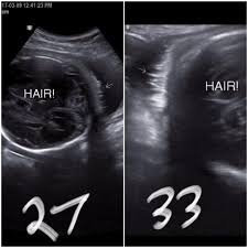 When i saw you i fell in love, and you smiled because you knew i love this quotation! Hair On Ultrasound Babycenter