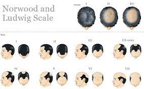 They took the time to explain everything that was being done and made me very ease. Male Pattern Hair Loss Village Dermatology