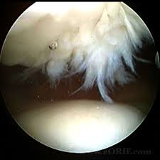 Patellofemoral Pain M25 569 719 46 Eorif