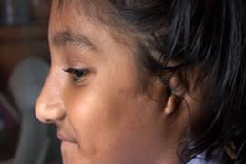 Scarred by acid in Bangladesh