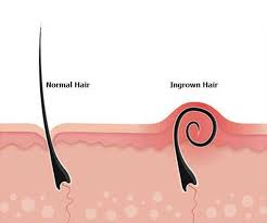 Check out our ingrown hair spots selection for the very best in unique or custom, handmade pieces from our there are 144 ingrown hair spots for sale on etsy, and they cost $18.54 on average. Ingrown Hairs And How To Deal With Them Wicked Wax