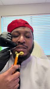 Lip Flip and Gummy Smile Transformation