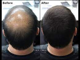 Yes, natural fibers make this product 100% safe for all users as it does not cause any side effects or allergies. Thick Fiber Hair Building Fibers Is A Hair Loss Concealer Fiber Cover Up Bald Patches Youtube