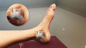 Tarsal Tunnel Syndrome Sports Medicine Information
