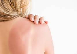 Si le coup de soleil couvre plus de 10 % de la surface totale du corps. Soigner Naturellement Les Coups De Soleil