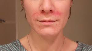 Perioral Dermatitis Eczema Meet Acne Skincareremediesbakingsoda Wrinklesmassage Perioral Dermatitis Perioral Eczema Treatment
