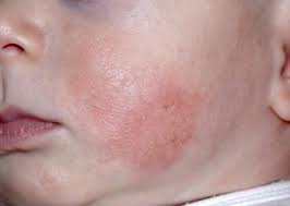 Illness Infections Babycenter Baby Cheeks Baby Rash Baby Eczema