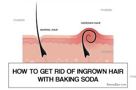Use shaving cream and aftershave to soothe the skin. Baking Soda For Ingrown Hair Does It Work