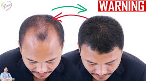 This classification also includes early hair loss in the crown area. Stage Wise Hair Loss Treatment In Men Early Signs Stages Of Male Pattern Baldness Youtube