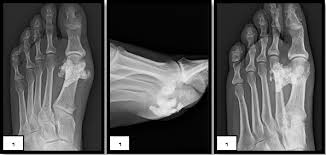 Mri of the soft tissues of the foot visualizes the fat cushions of the sole, heels, fingers and can show swelling, foci of infiltration and inflammation. Key Pearls On Diagnosing And Addressing Leiomyoma Of The Foot Podiatry Today