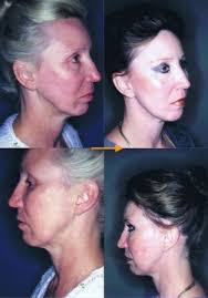 Double Eyelid Surgery in Tokyo, Japan, Eyelid Surgery, Liposuction, Breast  Augmentation, Breast lift (Mastopexy), Facelifts