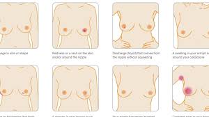 Inflammatory breast cancer or ibc is one of the forms of breast cancer causes the solid lump tumors. Breast Cancer Symptoms Are More Than A Lump Here Are The Other Signs To Look For Huffpost Uk Life