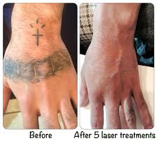 Treatments are spaced at least 8 weeks apart. Laser Tattoo Removal At Ink Affliction Natalie Abbott Racine Wi Laser Tattoo Removal Laser Tattoo Tattoos