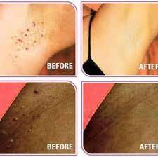 Ingrown hair is not comfortable. Legole Anti Ingrown Hair Serum Odour Eliminator Skin Rejuvinatoon Reviews Facebook