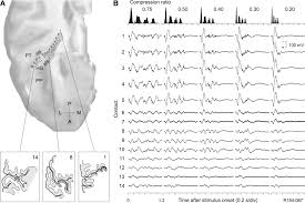 Perceptual adjustment to highly compressed speech: Temporal Envelope Of Time Compressed Speech Represented In The Human Auditory Cortex Journal Of Neuroscience