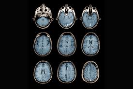 Incidental Ischaemic Changes On Mri Gponline