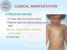 Meaning of branny desquamation medical term. Measles éº»ç–¹ Measles Rubeola Department Of Pediatrics Soochow University Affiliated Children S Hospital Ppt Download