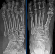 Image result for Ankle XRay