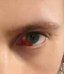 I Sneezed So Hard A Blood Vessel Burst In My Eye Wellthatsucks