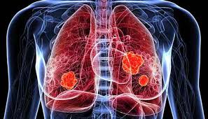 It is way too broad. Lung Cancer Four Important Facts You Should Know About Answers Republic