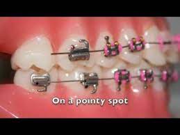 Sometimes A Song Won T Get Out Of Your Head Poker Face Was Played Enough At The Office That This Version Gradually To Orthodontics Poker Face Dental Braces