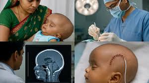 Image result for Hydrocephalus