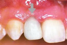 If your tooth is broken, chipped, or fractured, see your dentist as soon as possible. Dental Cement Temporary Cementation And Permanent Cementation