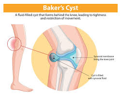 Image result for Knee Bulge Sign