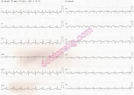 It can be seen in other pathologies causing right heart strain such as pneumothorax, pneumonia, and bronchospasm. Acute Pulmonary Embolism Embolus Akut Pulmoner Embolizm Emboli Ekg Ecg Ankara Kardiyoloji Kalp Hastaliklari Mete Alpaslan Doktorekg Com