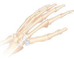 SpeedSpiral CMC Allograft System For CMC Joint Arthritis - Anika