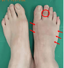 Complex Regional Pain Syndrome Australia Pdf Ppt Case Reports Symptoms Treatment