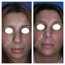 Ti torneranno molto utili quando, per. Correzione Della Punta Del Naso Estheticon It